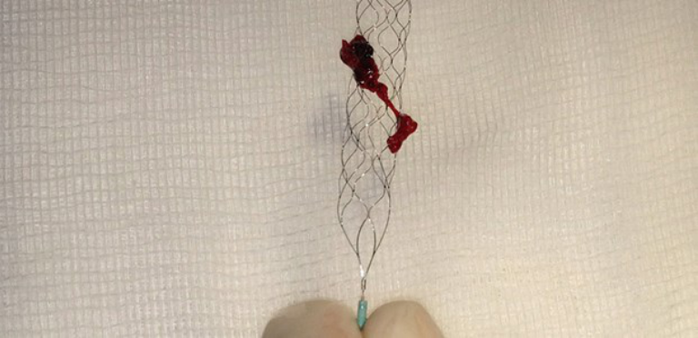 Thrombektomie